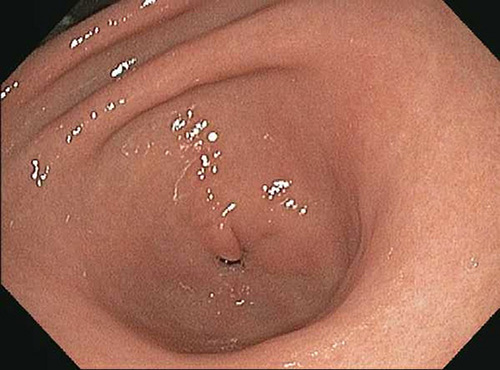 What bacteria is associated with gastritis in the abdominal antrum?